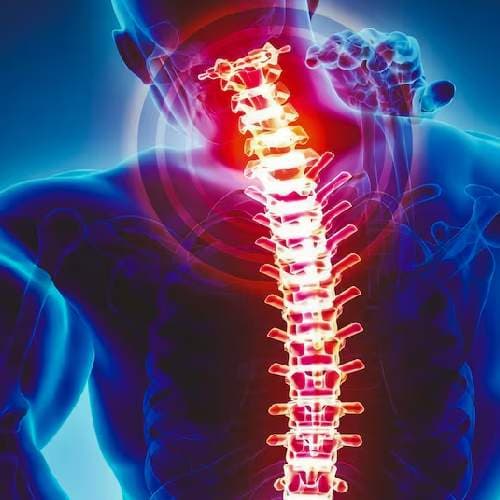 Cervical Spondylosis