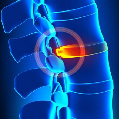 Herniated Disc