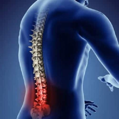 Lumbar Spondylosis